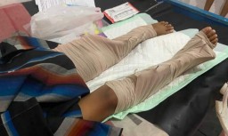 Kaki Ibu Tertimpa Tembok Roboh di Malang Akhirnya Diamputasi