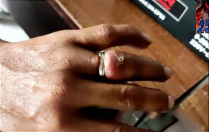 Jari Manis Pria Gresik Bengkak, Damkarla Potong Bagian Ini