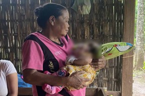 Tolong... Bayi Tanpa Batok Kepala di Ponorogo Butuh Bantuan