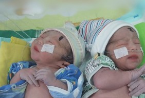 Kondisi Bayi Kembar Siam di Tulungagung Membaik, Bisa Rawat Jalan