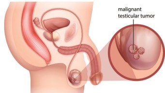Kanker Testis Tidak Bisa Diabaikan, Kenali Gejala dan Cara Penanganannya