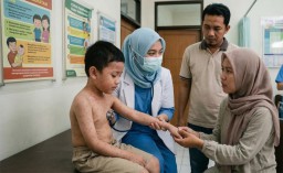 Mengenal Ciri Spesifik Campak Agar Tak Terlambat Penanganan Medis