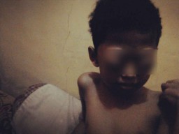 Bocah Penderita Tumor Mata di Banyuwangi, ini Kata Dokter