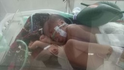Bayi Kembar Siam asal Lamongan Meninggal Dunia di RSU dr Soetomo