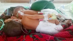 RSU dr Soetomo Tangani Bayi Kembar Siam Asal Lamongan