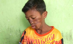 Bocah Disiram Air Keras Ayah Tiri ini Tak Sabar Tunggu Operasi Lagi