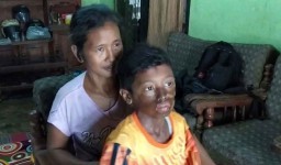 Kisah Samuel Kristian yang Disiram Air Keras oleh Ayah Tirinya