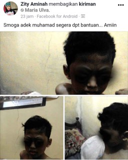 Viral! Derita Bocah 11 Tahun Terkena Tumor Mata