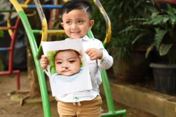 Stop Bullying! Jaga Kesehatan Mental Anak Penderita Bibir Sumbing