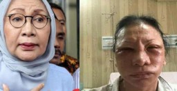 Tompi Sebut Bengkak Wajah Ratna Sarumpaet Bekas Operasi